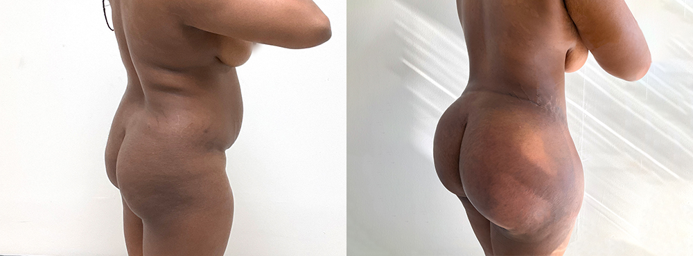 BBL Before and After