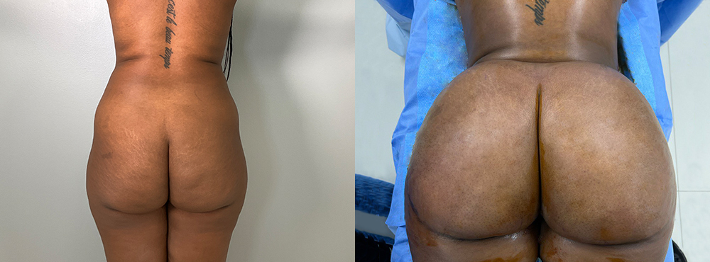 Brazilian Butt Lift before and after photo