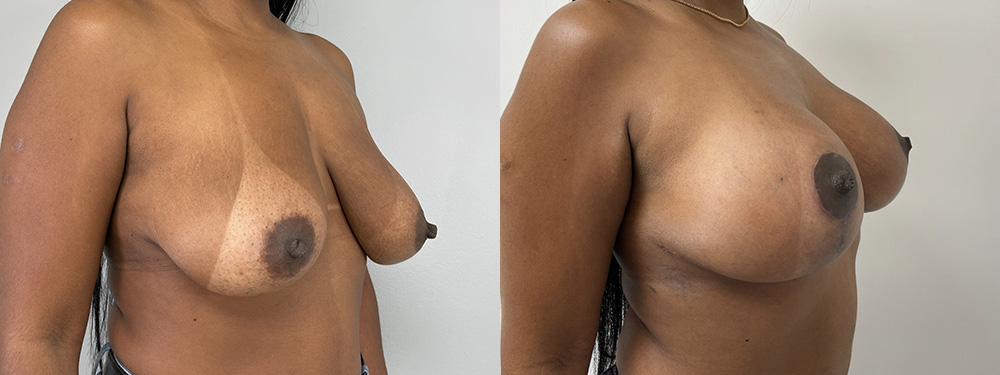 Breast Lift  Before and After