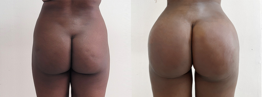 BBL Before and After