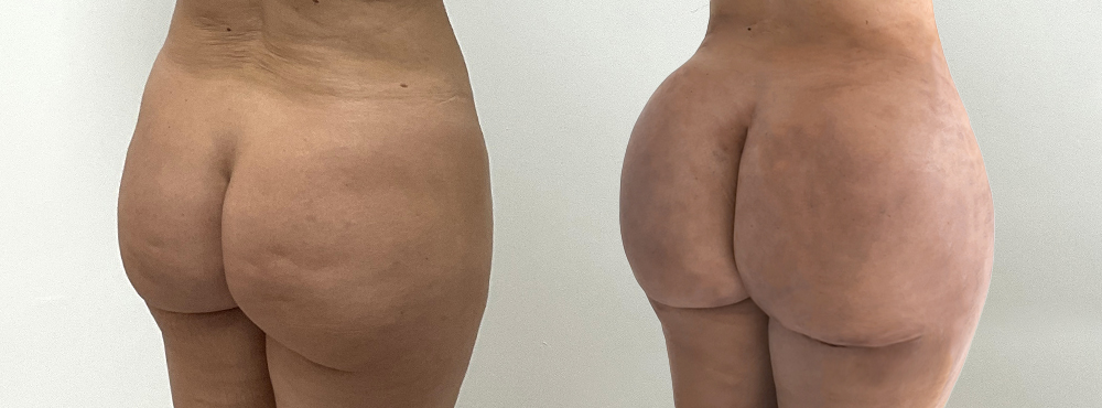 BBL Before and After