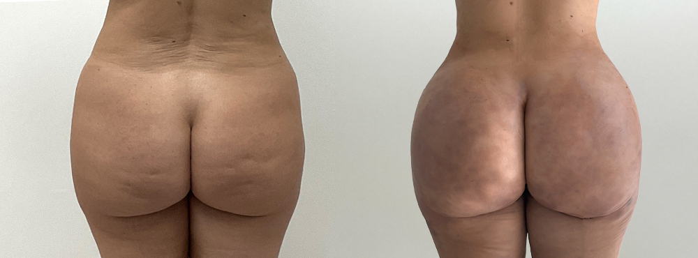 BBL Before and After