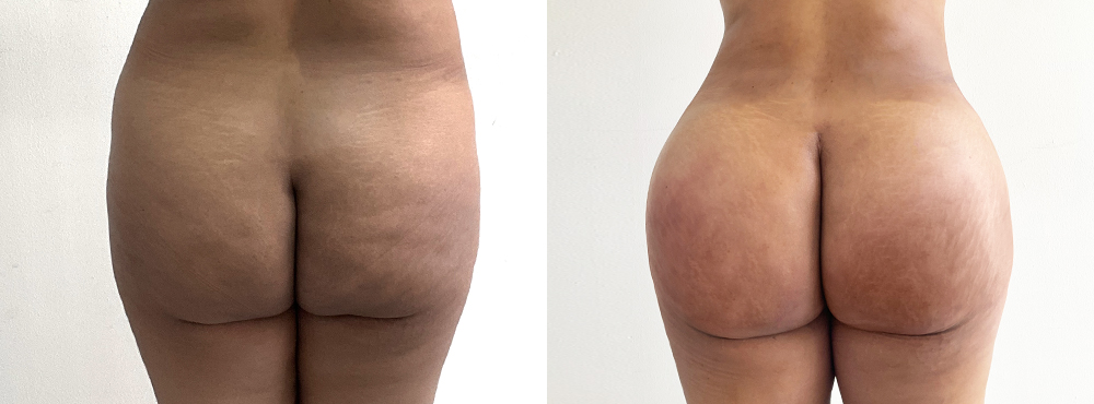 BBL Before and After