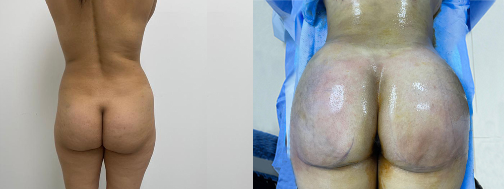 Brazilian Butt Lift before and after photos