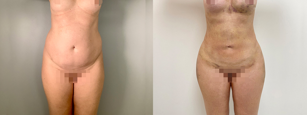 Liposucrion before and after photo