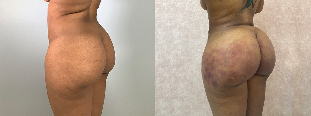 Brazilian Butt Lift before and after photo