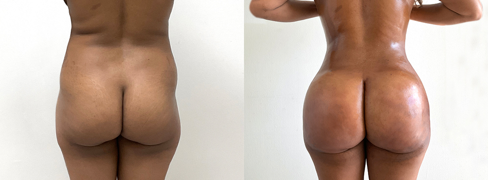 BBL Before and After