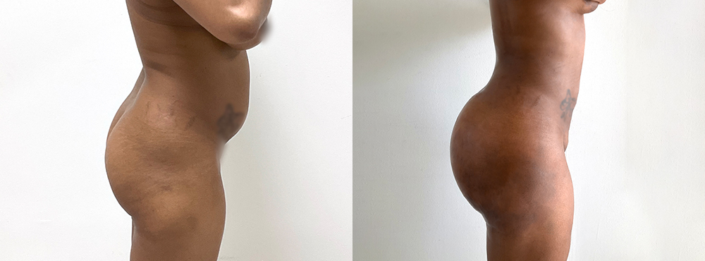 BBL Before and After