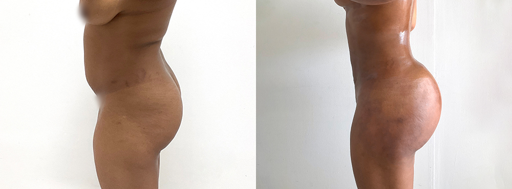 BBL Before and After