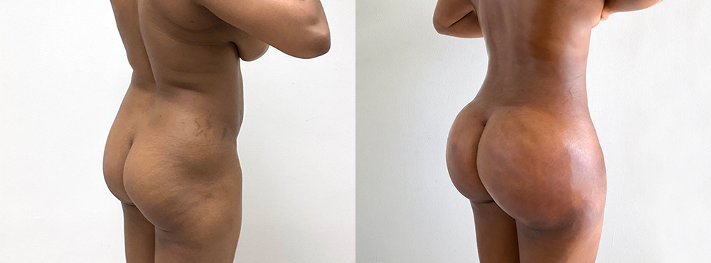 BBL Before and After