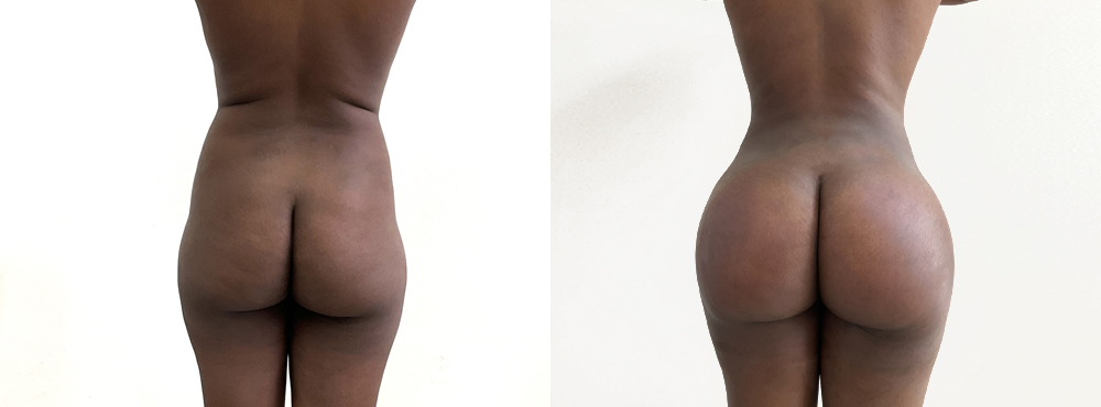 BBL Before and After