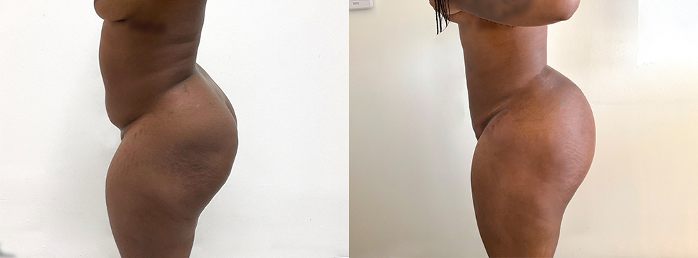 BBL Before and After