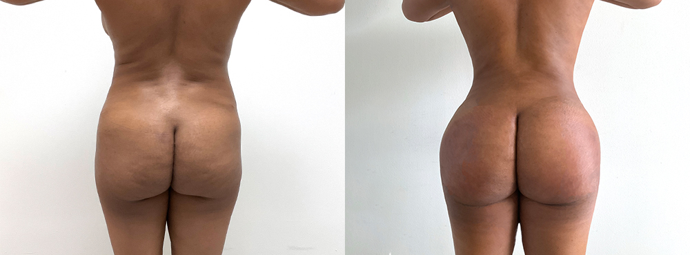 BBL Before and After