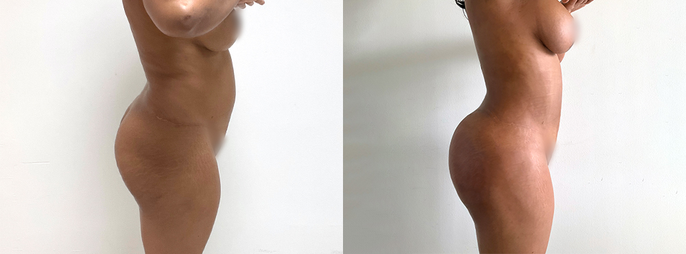BBL Before and After
