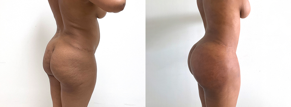 BBL Before and After