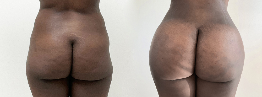 BBL  Before and After