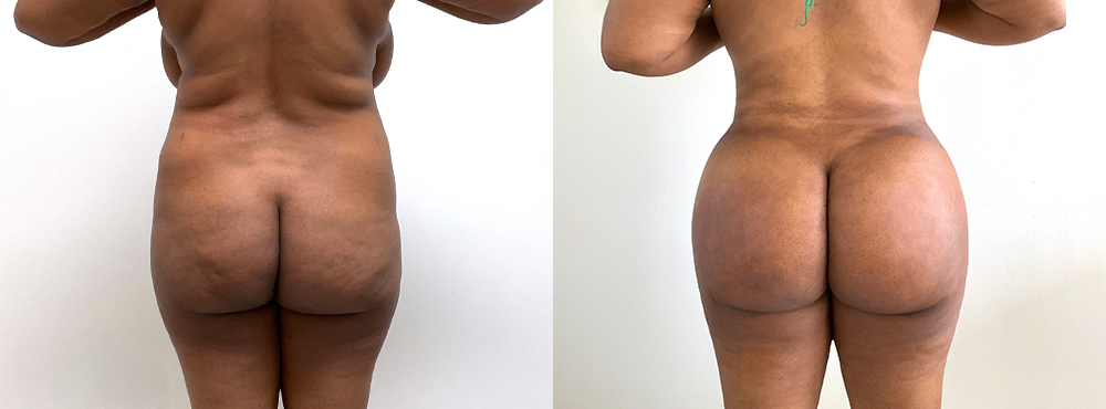 BBL Before and After