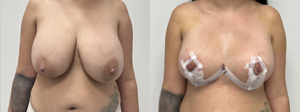 Breast Lift Before and After