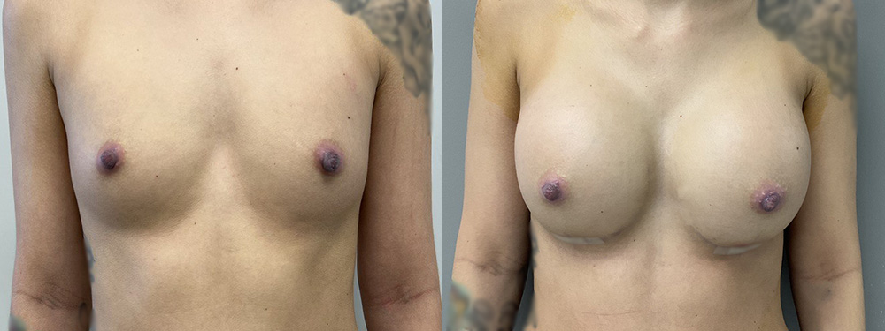 Breast Augmentation Before and After