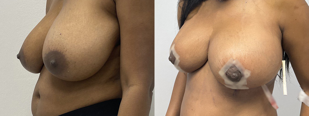 Breast Reduction Before and After