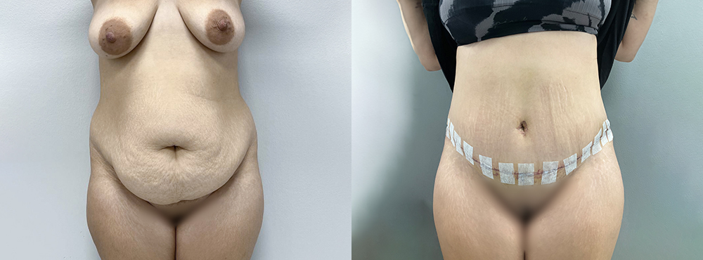 Tummy Tuck Before and After
