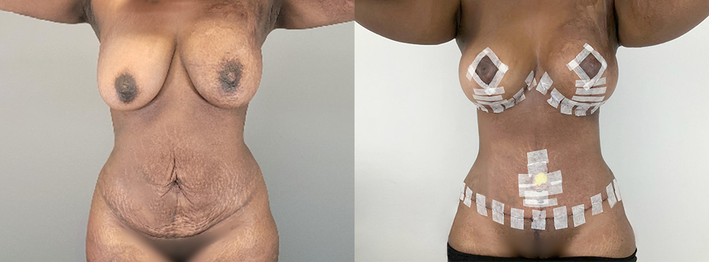 Mommy Makeover Before and After