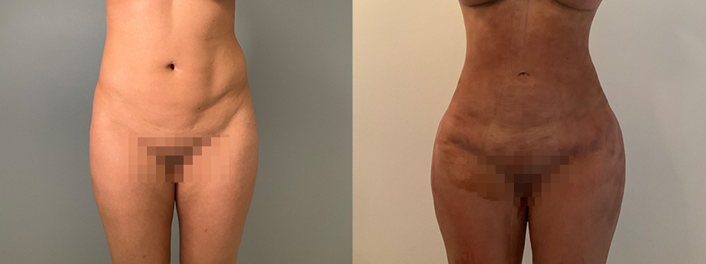 Liposuction before and after photo