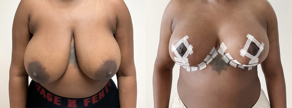 Breast Reduction Before and After