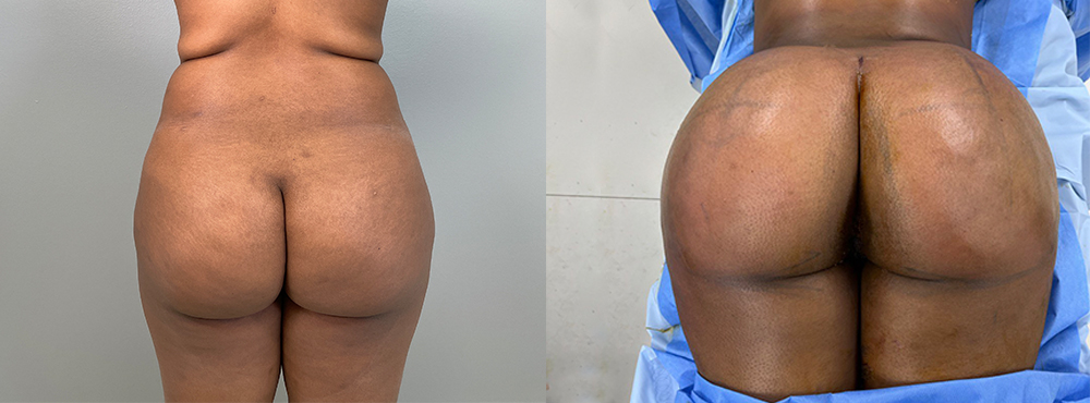 Brazilian Butt Lift before and after photo