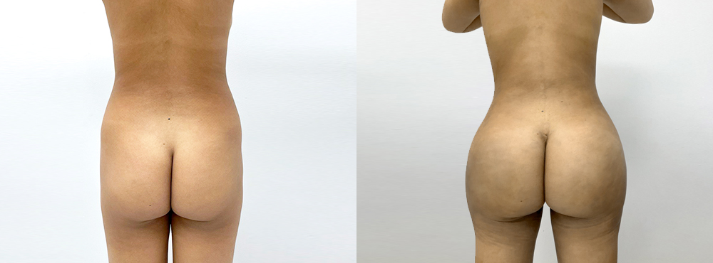 BBL Before and After