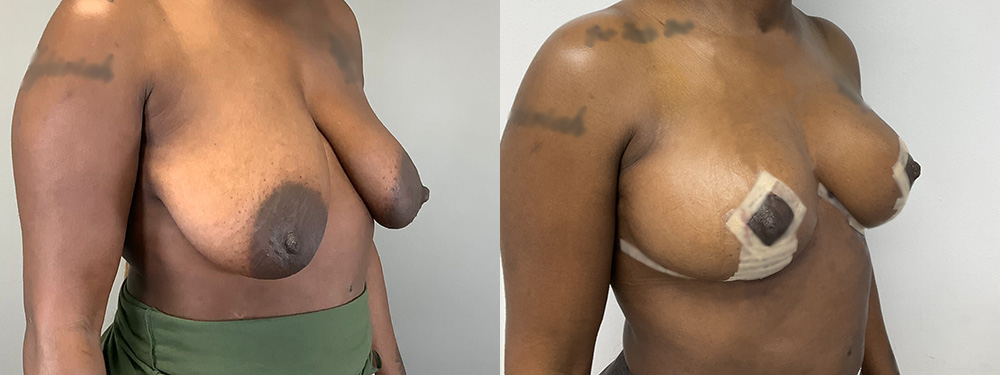Breast Lift Before and After