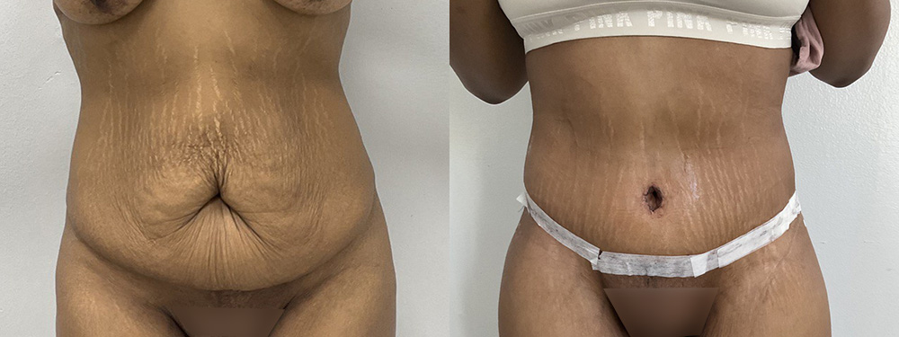 Tummy Tuck Before and After