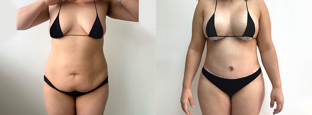 Mommy Makeover Before and After