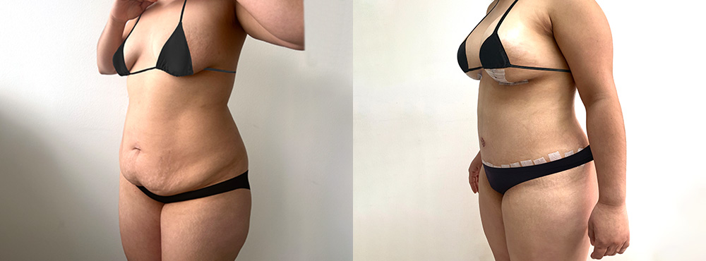 Mommy Makeover Before and After