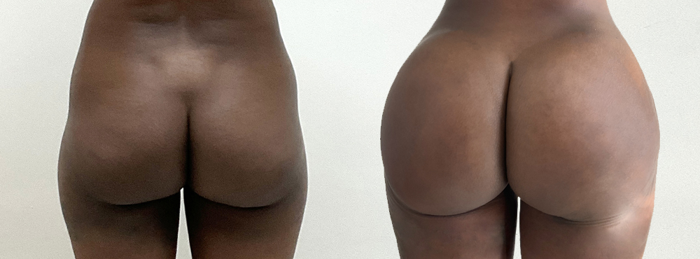 BBL Before and After