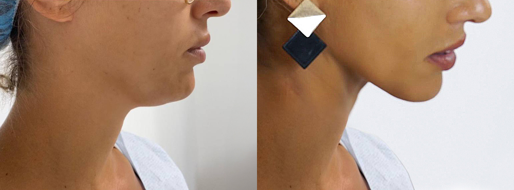 Chin Lipo Before and After