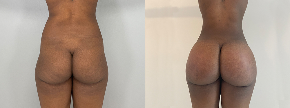 Brazilian Butt Lift before and after photo