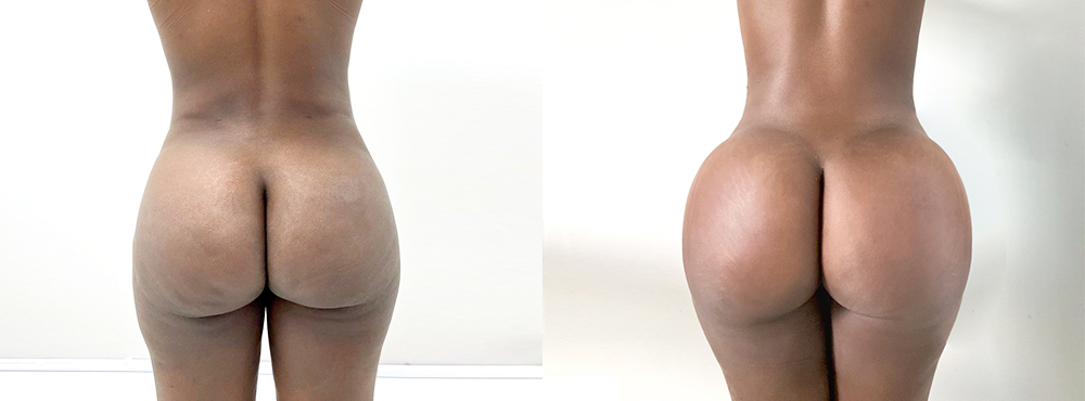 BBL Before and After