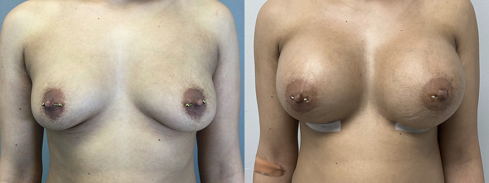 Breast Augmentation Before and After