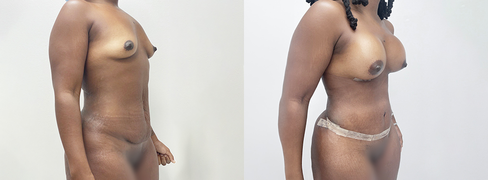 Breast Augmentation Before and After