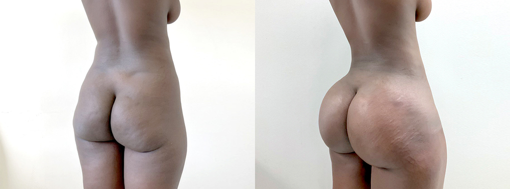 BBL Before and After