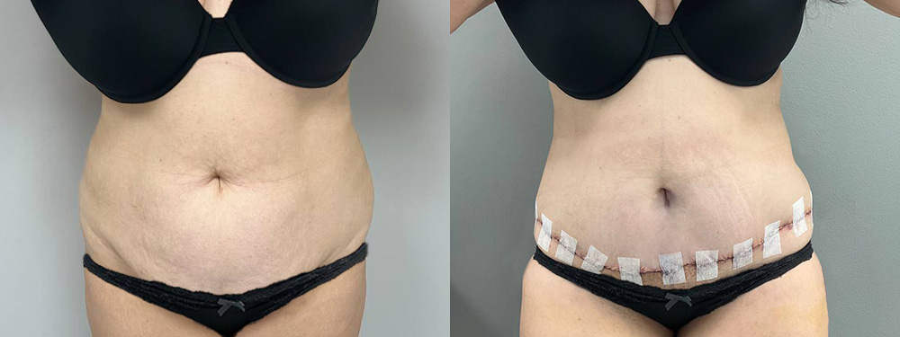 Tummy Tuck Before and After