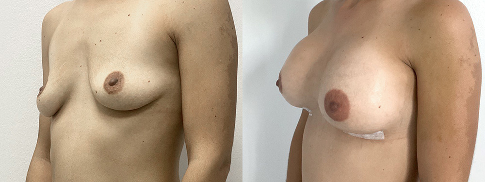 Breast Augmentation Before and After