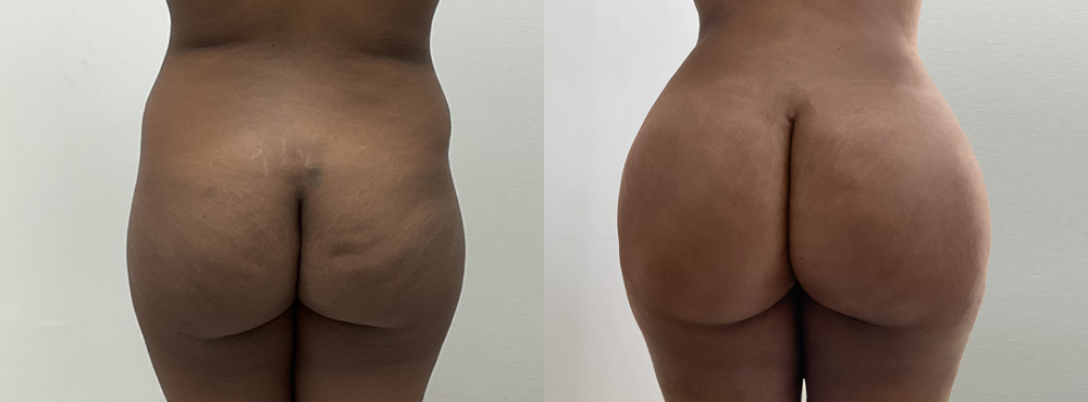 BBL Before and After