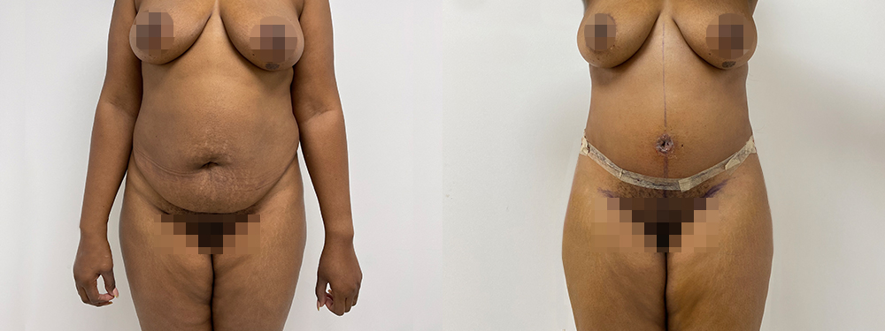 Tummy Tuck before and after photo