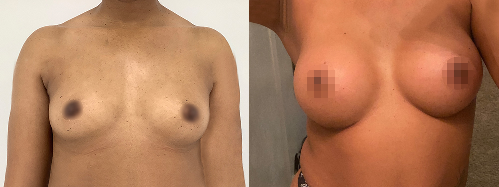 Breast Augmentation before and after photos