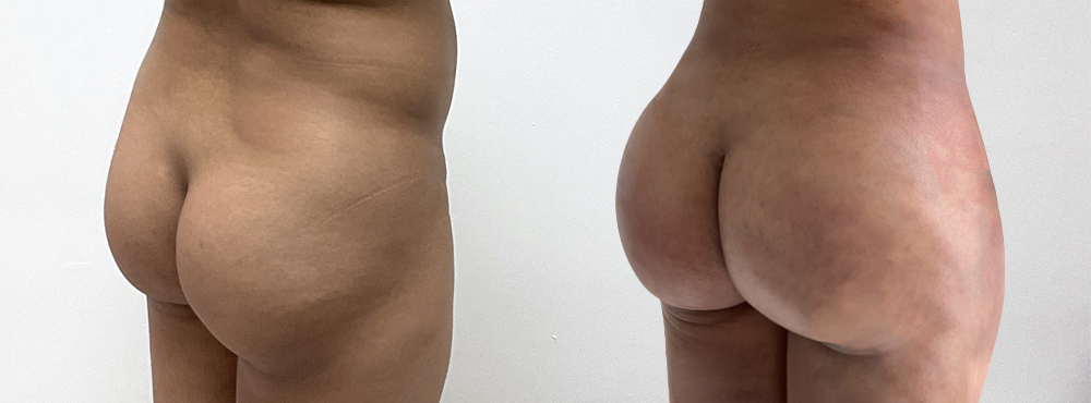 BBL Before and After