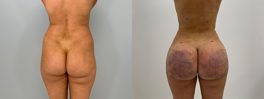 Brazilian Butt Lift before and after photo
