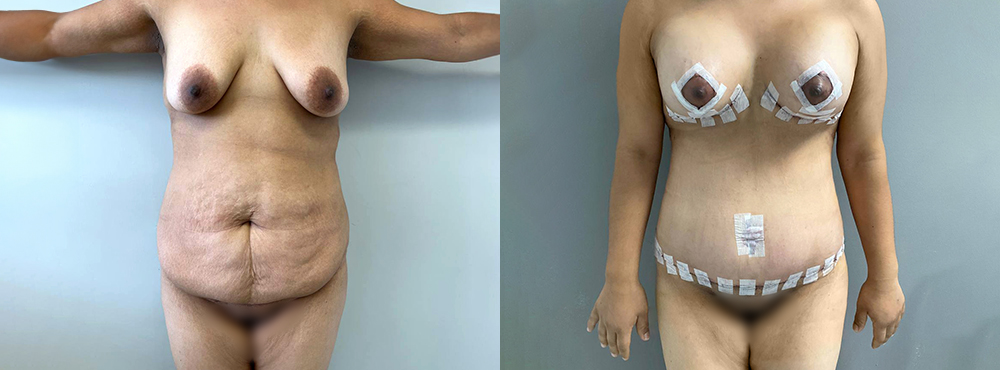 Mommy Makeover Before and After