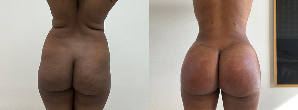 Brazilian Butt Lift before and after photo